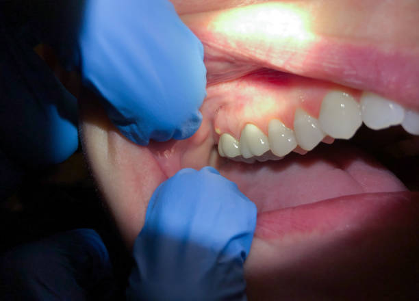 Best Urgent Dental Care for Toothache in Akwesasne, NY