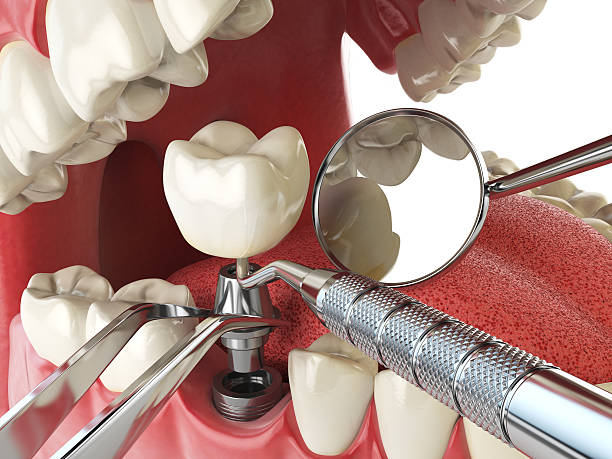 Best Emergency Dentist for Lost Fillings or Crowns in Akwesasne, NY